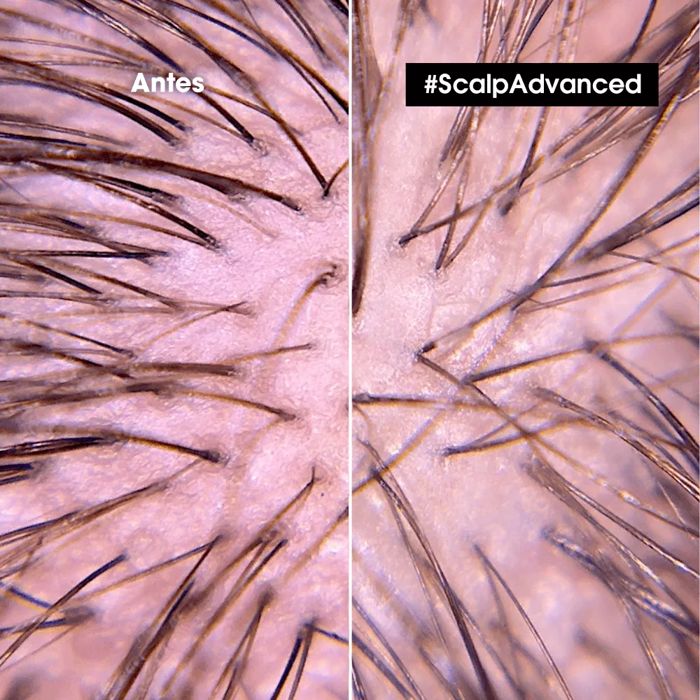 L'Oréal Professionnel Scalp Advanced Shampoo Anti Malestar 300ml